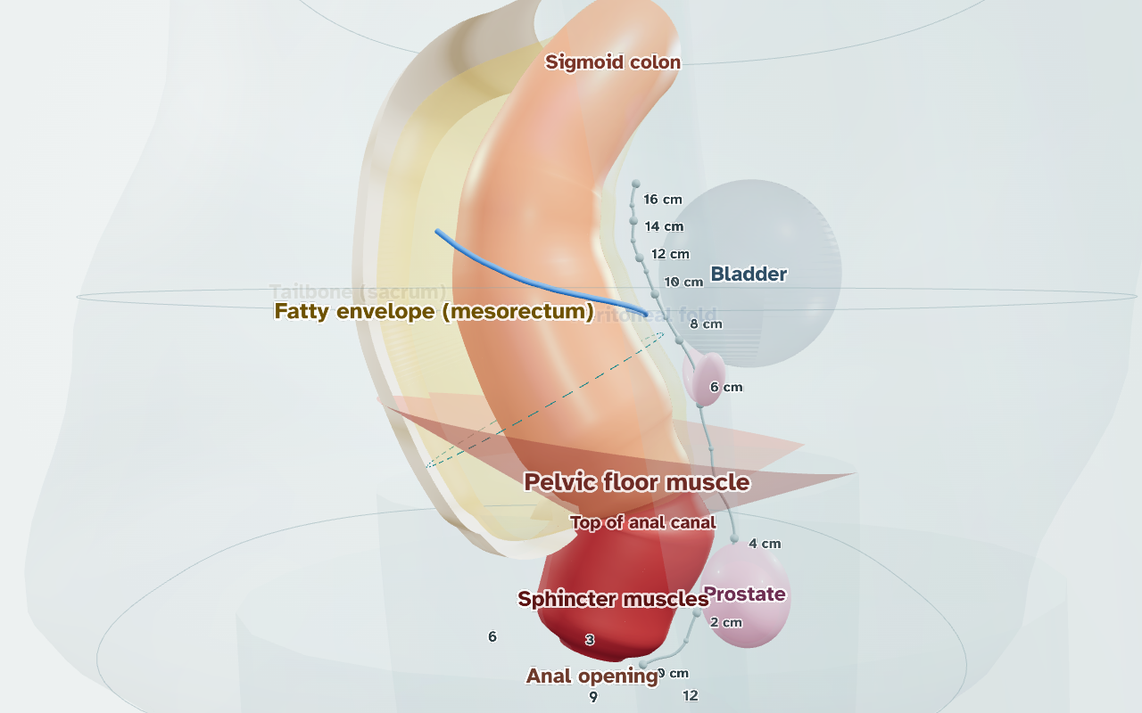 The rectal cancer explorer: a 3D model of the rectum with the tumour shown in purple, the fatty envelope around the bowel in yellow and labels naming each part.
